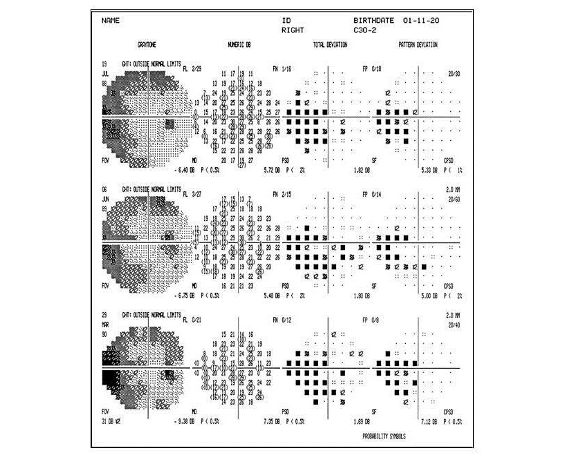 Visual field changes in glaucoma
