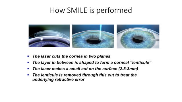 How SMILE is performed