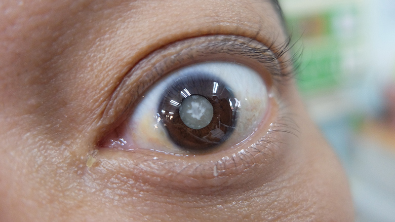 Secondary Cataracts: What They Are, Causes and Treatment