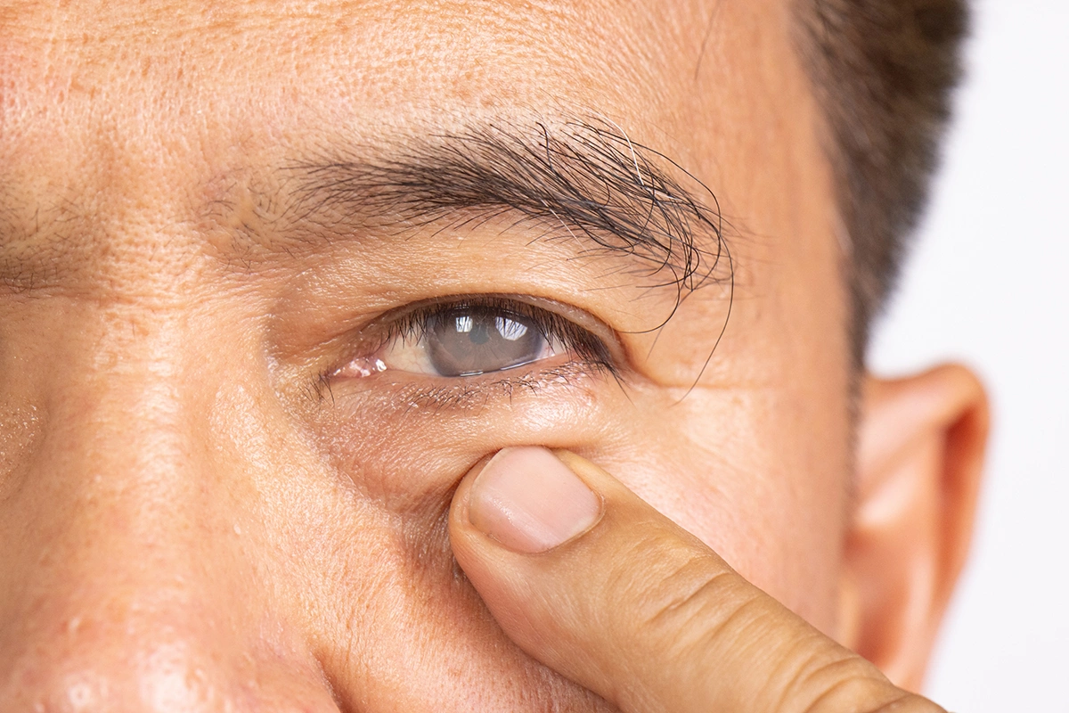 An elderly man with cataracts