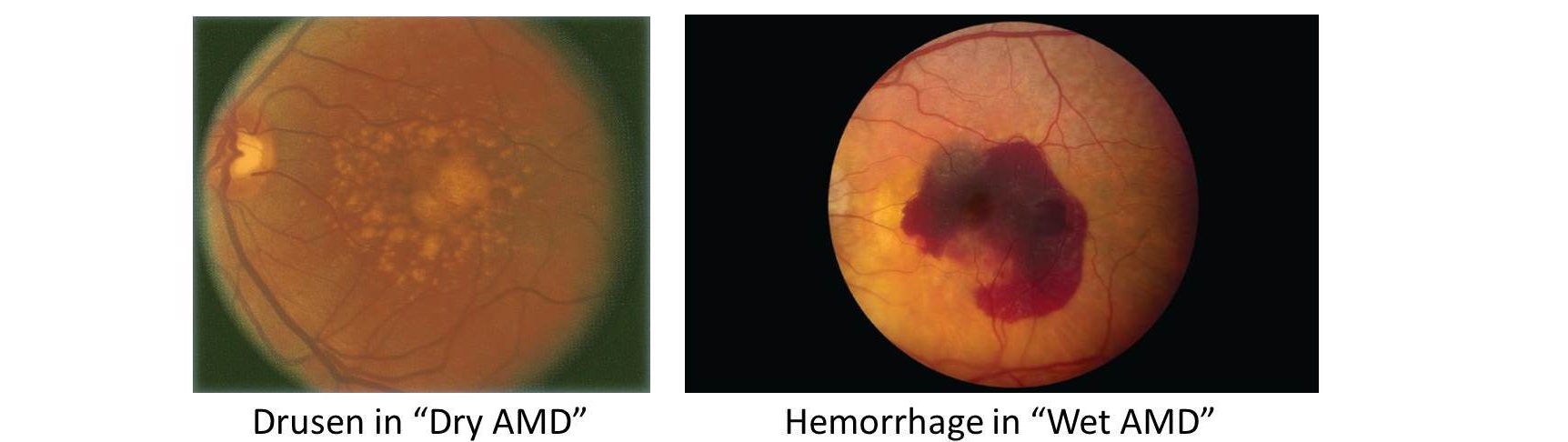 Age-related macular degeneration (AMD)