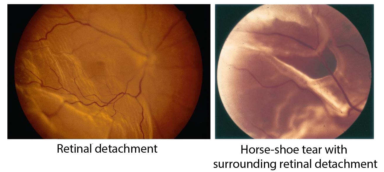 Retinal Detachment